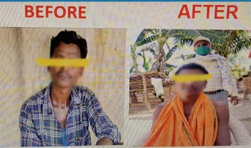 कुष्ठ रोग का समय पर हुआ इलाज - अब मरीज सम्मानजनक जीवन जी रहे है कुष्ठ रोग का समय पर हुआ इलाज - अब मरीज सम्मानजनक जीवन जी रहे है