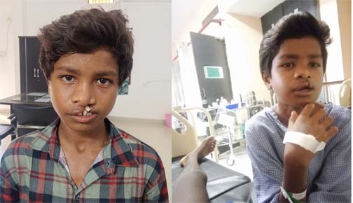 'चिरायु' दल ने लौटाई मुस्कान, जन्मजात कटे होंठ और तालु से मिली मुक्ति 'चिरायु' दल ने लौटाई मुस्कान, जन्मजात कटे होंठ और तालु से मिली मुक्ति