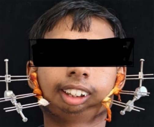 जटिल सर्जरी से खुला मुंह, आयुष्मान योजना से मिला निःशुल्क उपचार जटिल सर्जरी से खुला मुंह, आयुष्मान योजना से मिला निःशुल्क उपचार