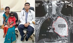 अम्बेडकर अस्पताल  में  3 साल की बच्ची के फेफड़े से निकला 1.5 किलोग्राम का ट्यूमर