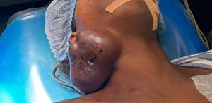  बैगा जनजाति की 25 वर्षीय महिला में मिला दुर्लभ कैंसर