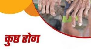  राजनांदगांव जिले में सघन कुष्ठ जांच खोज अभियान 31 दिसंबर तक