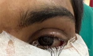  स्किन ग्राफ्टिंग से मरीज के पलक का सफल पुनर्निर्माण...