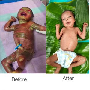  सुदूर बीजापुर में चिकित्सा चमत्कार : अत्यंत दुर्लभ बीमारी से जूझते शिशु को बचाया