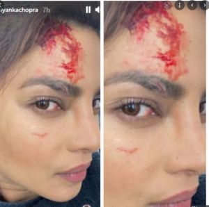  शूटिंग के दौरान फूटा प्रियंका का सिर....शेयर की फोटो