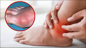 स्किन पर दिखते हैं यूरिक एसिड बढ़ने के ये चार लक्षण स्किन पर दिखते हैं यूरिक एसिड बढ़ने के ये चार लक्षण