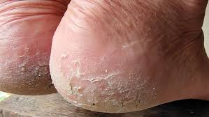 फटी एड़ियों के कारण चलने में हो रही है दिक्कत, एलोवेरा और देसी घी से मिलेगा आराम फटी एड़ियों के कारण चलने में हो रही है दिक्कत, एलोवेरा और देसी घी से मिलेगा आराम