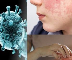   त्वचा पर ये लक्षण दिखने पर तुरंत करवाएं कोविड-19 टेस्ट