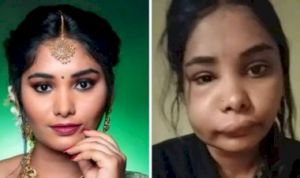  रूट कैनाल गलत होने से बिगड़ा एक्ट्रेस स्वाति सतीश का चेहरा, जानें इस सर्जरी में कौन सी सावधानियां हैं जरूरी