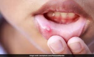 मुंह के छालों का करें घरेलू इलाज, इन चीजों को लगाने से मिलेगा आराम