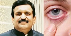   कंजंक्टिवाइटिस में सावधानी रखने से बचाव सम्भव - .डॉ दिनेश मिश्र