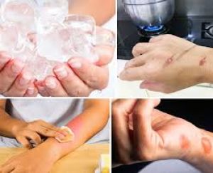  किचन में काम करते समय जल गई है त्वचा, तो राहत पाने के लिए अपनाएं ये घरेलू उपाय