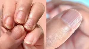  नाखूनों में ऐसी लाइनें दिखना कहीं शरीर में किसी चीज की कमी तो नहीं?  
