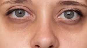 आंखों के नीचे डार्क सर्कल? ये 3 घरेलू नुस्खे अपनाएं 