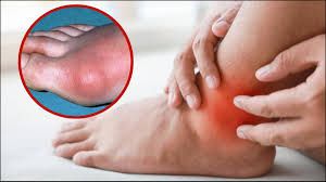 स्किन पर दिखते हैं यूरिक एसिड बढ़ने के ये चार लक्षण स्किन पर दिखते हैं यूरिक एसिड बढ़ने के ये चार लक्षण