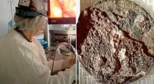  50 साल से शख्स के नाक में फंसी थी ये चीज, डॉक्टर भी रह गए हैरान 