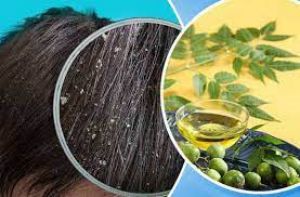 बालों की रुसी से हैं परेशान.... तो करें नीम का ऐसे इस्तेमाल