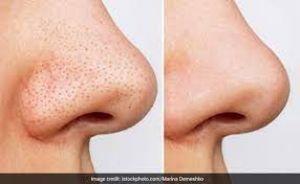  हो गए हैं चेहरे पर ब्लैक हेड्स ? करें ये आसान उपाय...