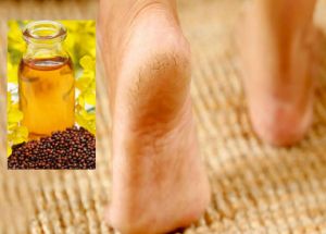 फटी एड़ियों से छुटकारा पाने के लिए लगाएं सरसों के तेल से बना फुट मास्क फटी एड़ियों से छुटकारा पाने के लिए लगाएं सरसों के तेल से बना फुट मास्क