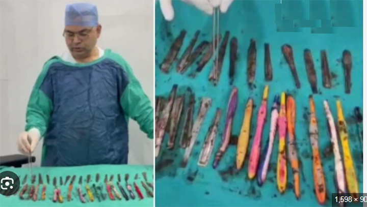 डॉक्टरों ने नशे की लत के मरीज के पेट से पेन, टूथब्रश और चम्मच निकाले डॉक्टरों ने नशे की लत के मरीज के पेट से पेन, टूथब्रश और चम्मच निकाले